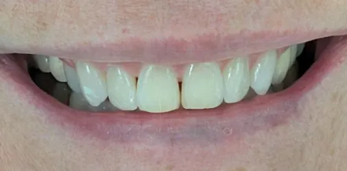 SureSmile® Aligners