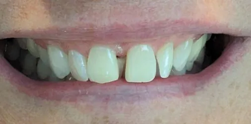 Smile before SureSmile aligner treatment